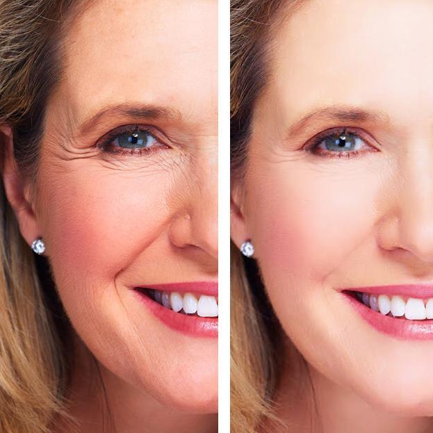 Side-by-side comparison of a woman's face with and without cosmetic treatment.