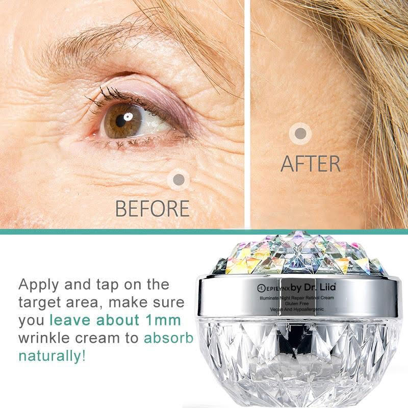 EpiLynx by Dr. Liia Retinol Cream before and after picture